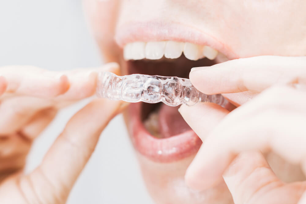 Judge frowns on Invisalign's lawsuit against SmileDirectClub - Lawyerly